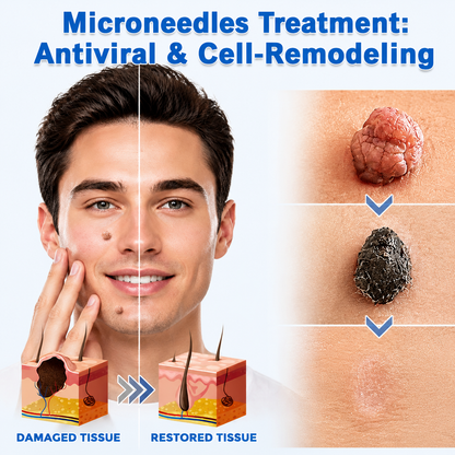 🔥 LAST DAY SALE-80% OFF ✨ Curalona®2-in-1 Microneedle & Hydrocolloid Patch🍀| Removes Raised Moles, Acne, Flat Warts & Skin Tags | Helps Improve Wrinkles, Scars & Blemishes | Invisible Patches for Face & Body
