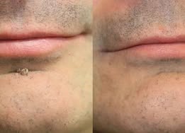 🔥 LAST DAY SALE-80% OFF ✨ Curalona®2-in-1 Microneedle & Hydrocolloid Patch🍀| Removes Raised Moles, Acne, Flat Warts & Skin Tags | Helps Improve Wrinkles, Scars & Blemishes | Invisible Patches for Face & Body