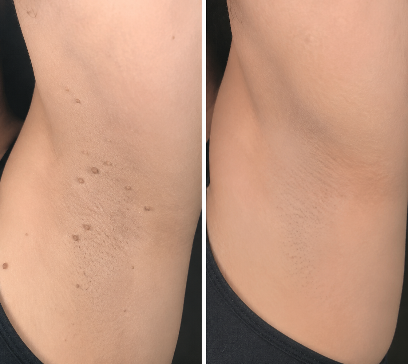 🔥 LAST DAY SALE-80% OFF ✨ Curalona®2-in-1 Microneedle & Hydrocolloid Patch🍀| Removes Raised Moles, Acne, Flat Warts & Skin Tags | Helps Improve Wrinkles, Scars & Blemishes | Invisible Patches for Face & Body