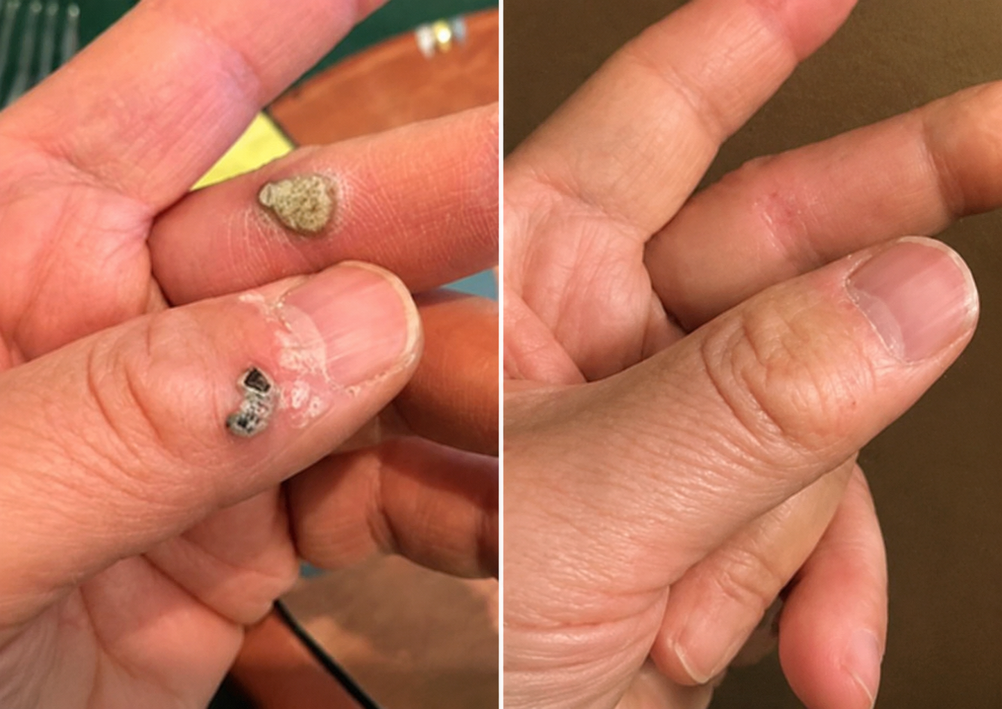 🔥 LAST DAY SALE-80% OFF ✨ Curalona®2-in-1 Microneedle & Hydrocolloid Patch🍀| Removes Raised Moles, Acne, Flat Warts & Skin Tags | Helps Improve Wrinkles, Scars & Blemishes | Invisible Patches for Face & Body
